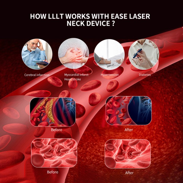 Neck Laser Instrument - Enhance Blood Circulation Efficiently