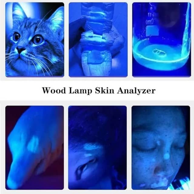 Woods Lamp Skin Analyzer - Portable UV Light for Accurate Skin Examination